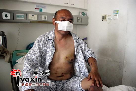 新疆沙灣村民山中撿玉遭棕熊攻擊 鼻子、上嘴唇被咬掉撿回一命（圖）
