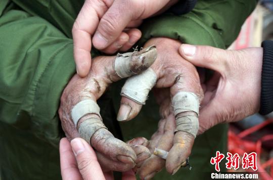 圖為由于常年拾荒，老人雙手布滿傷口。周小云 攝