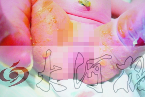 全身被燙傷43% 全身被燙傷43%