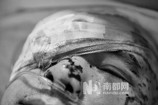 李建新頭部還有被潑硫酸的痕跡，醫(yī)生說被砍傷的右眼已經(jīng)失明。 南都記者 田飛 攝