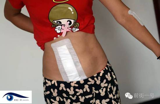 小金腹部的傷口。