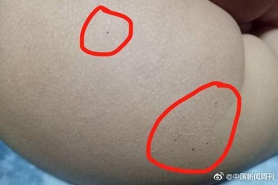 據(jù)多名紅黃藍(新天地分園)家長反映，孩子腿部、屁股、腋下出現(xiàn)針眼。