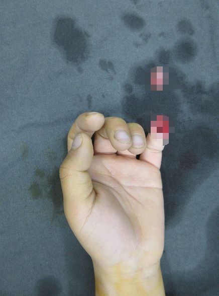 嚇哭！6歲男孩被夾斷手指 罪魁禍首竟是校服