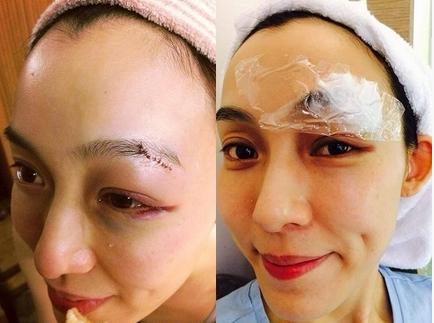 范瑋琪臉撞地濺血縫25針 范瑋琪臉撞地濺血縫25針