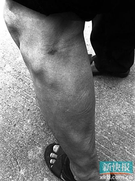 傷者身上遺留的彈痕。