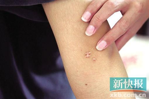 取出針后李星兒手臂留下了傷口。新快報記者 張國鋒/攝