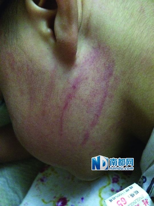 小逸臉上淤痕清晰可見。